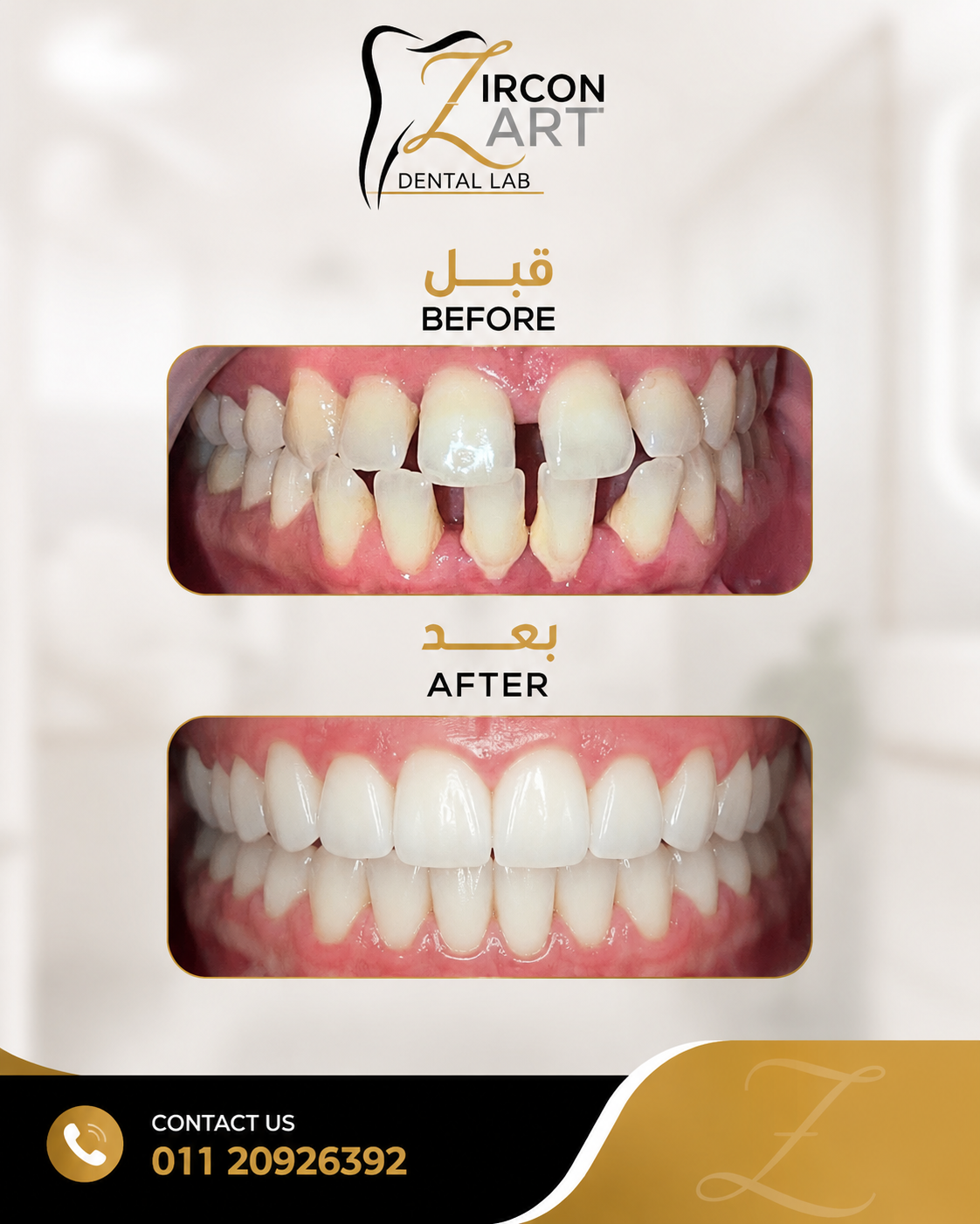 Before and after photo of a complete smile transformation using premium veneers by Zircon Art Dental Laboratory